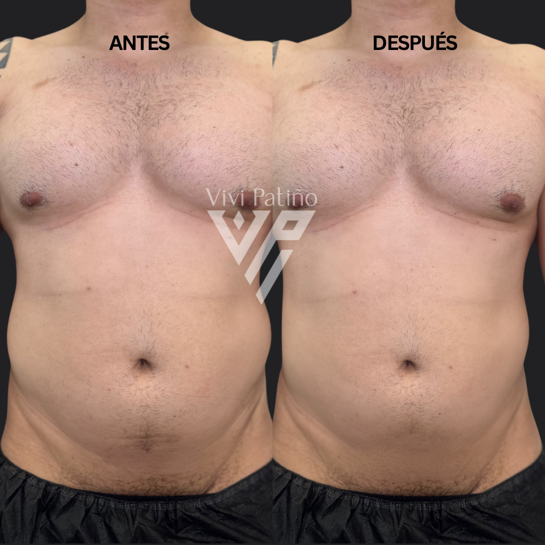 BODY REDUCTION