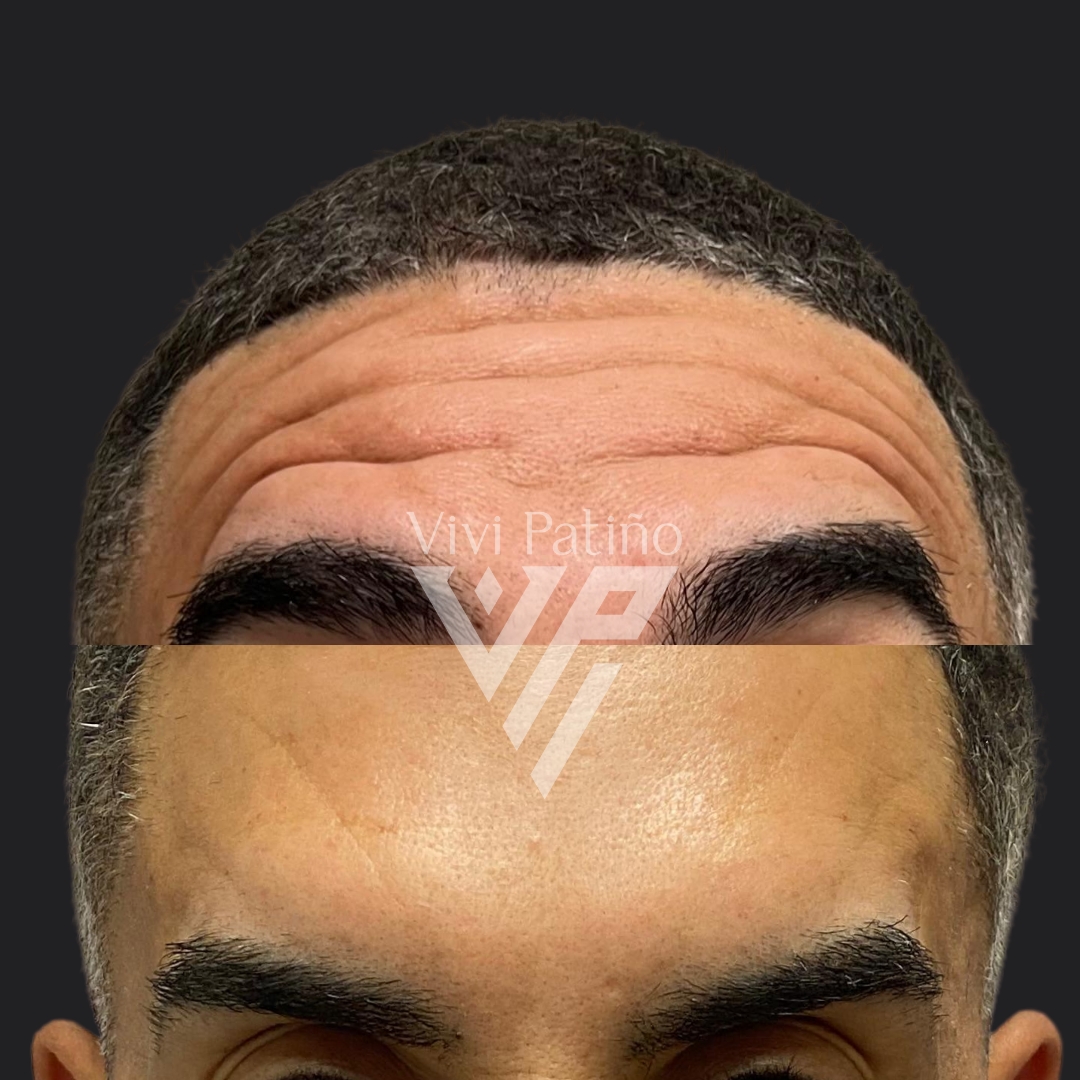 BOTOX