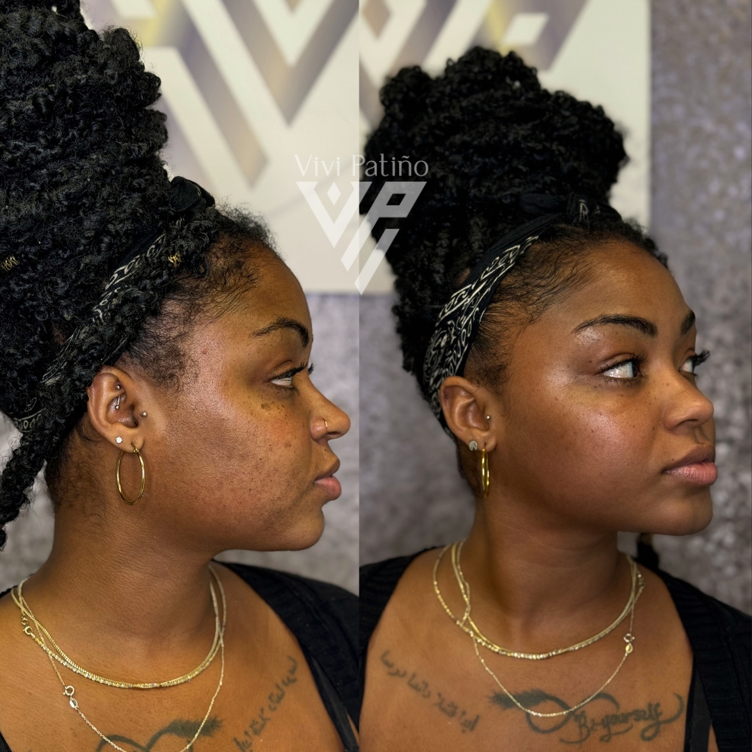 CHIN AUGMENTATION