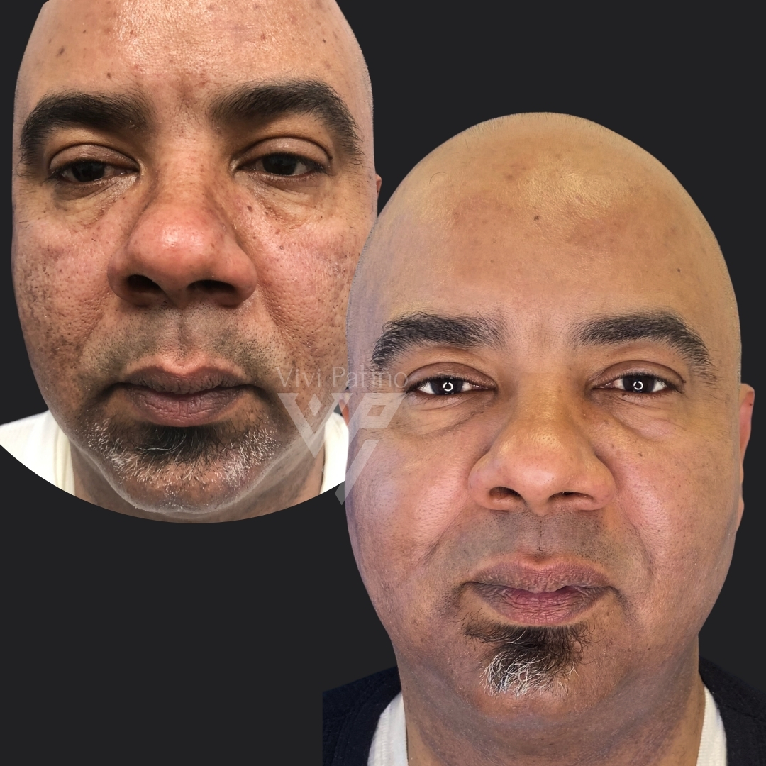 FACIAL REJUVENATION 3