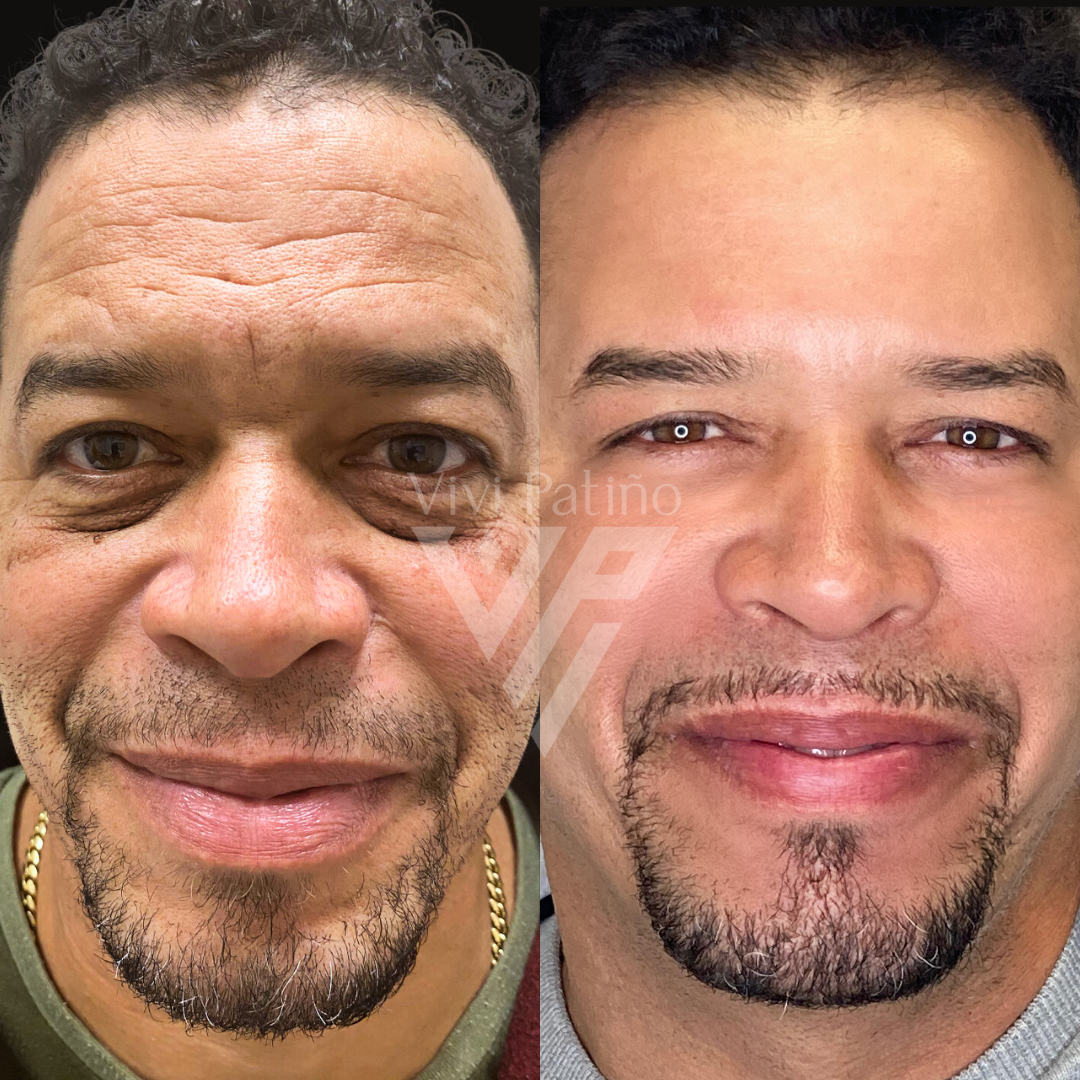 FACIAL REJUVENATION