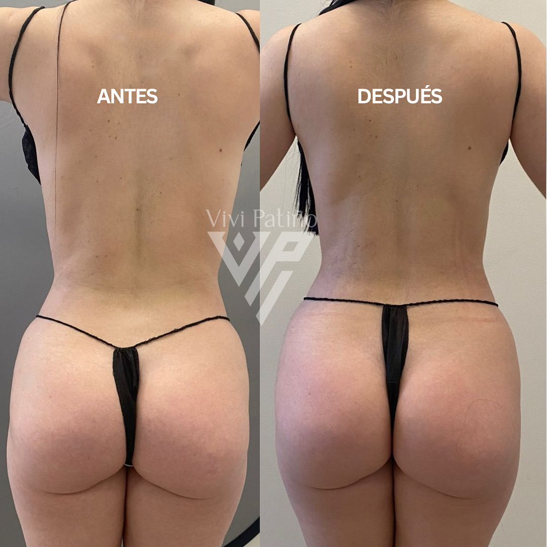 MASSAGE REDUCTION