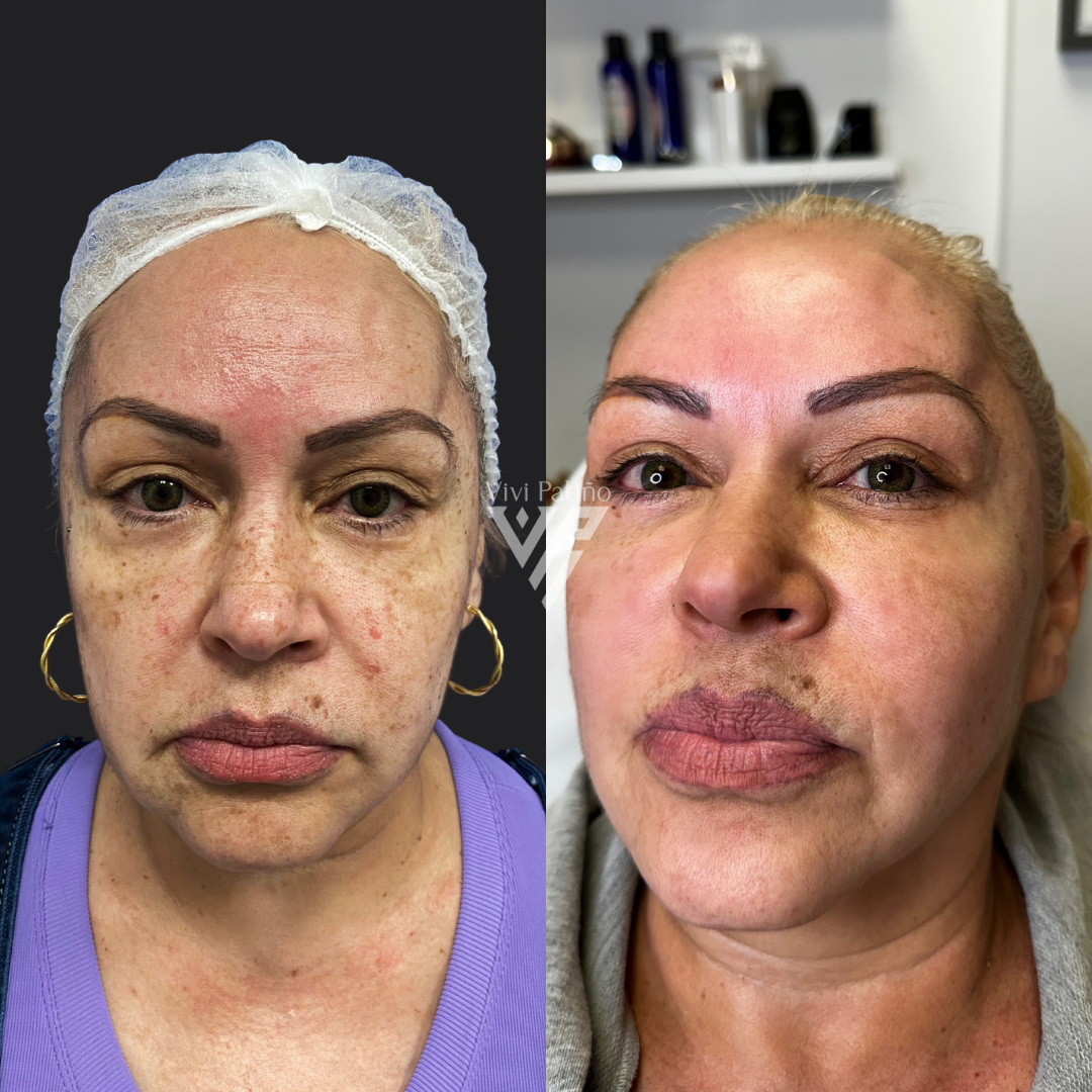 MELASMA TREATMENT_2