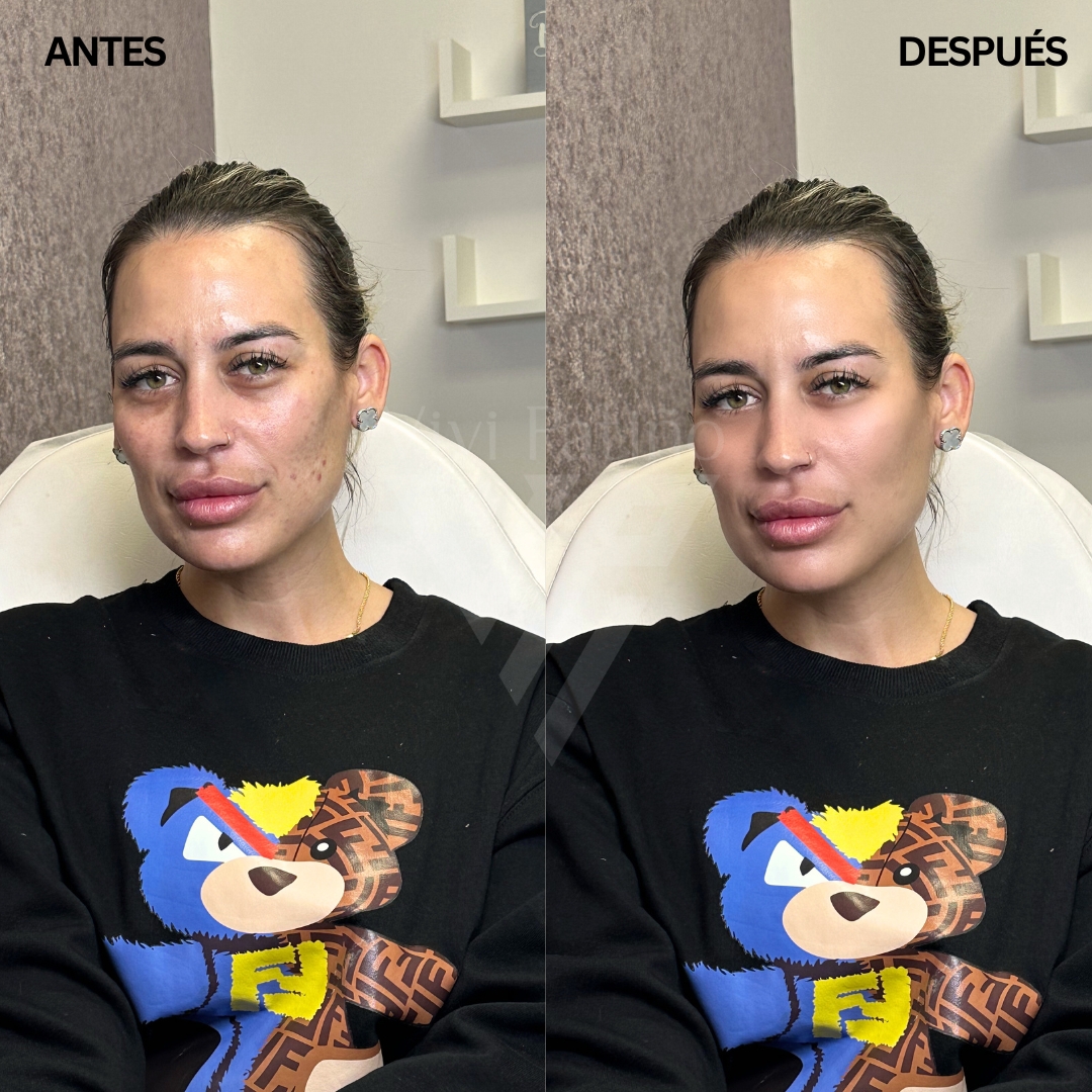 SCULPTRA