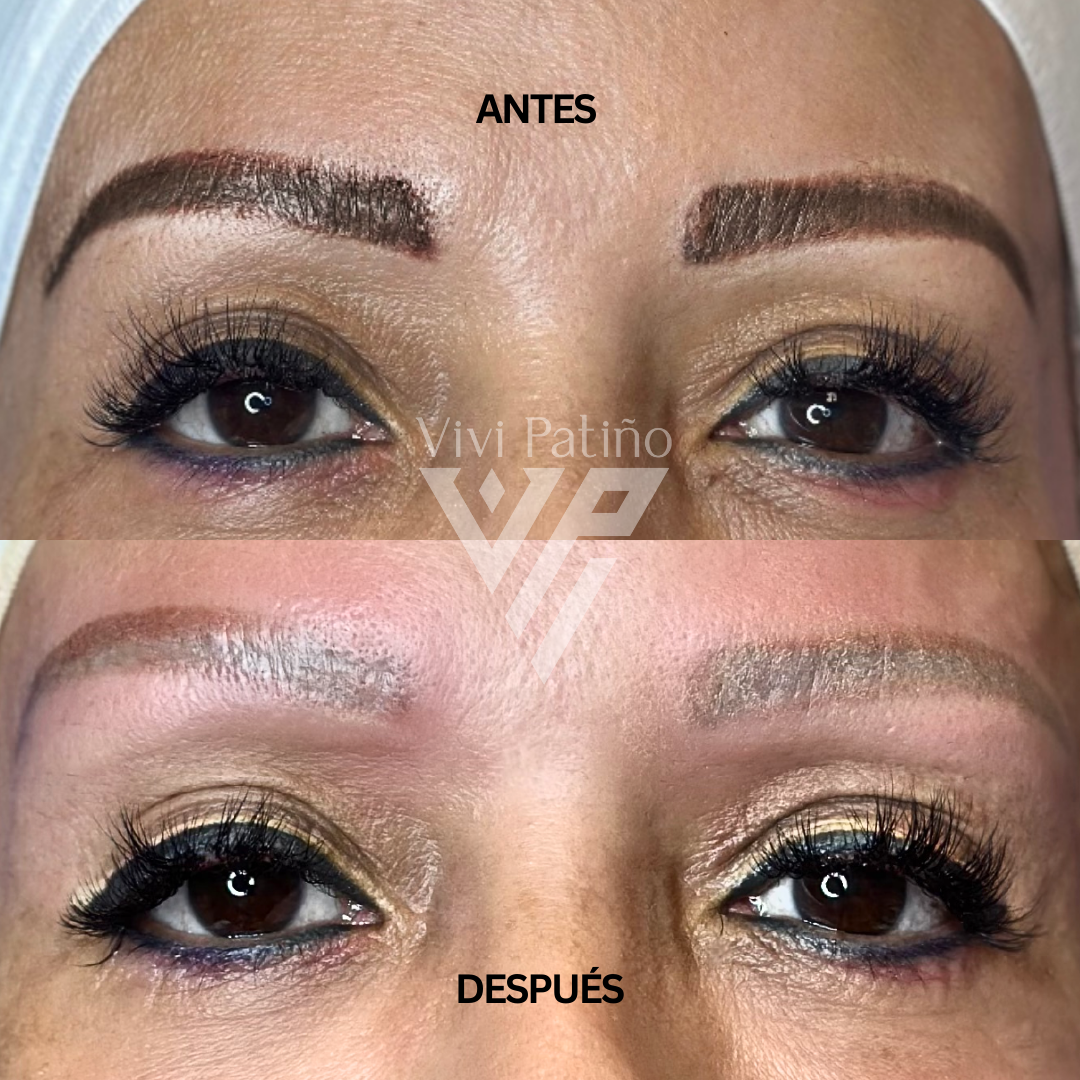 TATTO REMOVAL